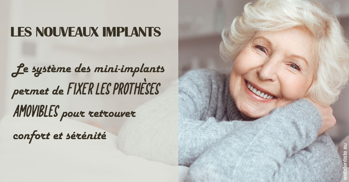 https://dr-bauer-patrick.chirurgiens-dentistes.fr/Les nouveaux implants 1