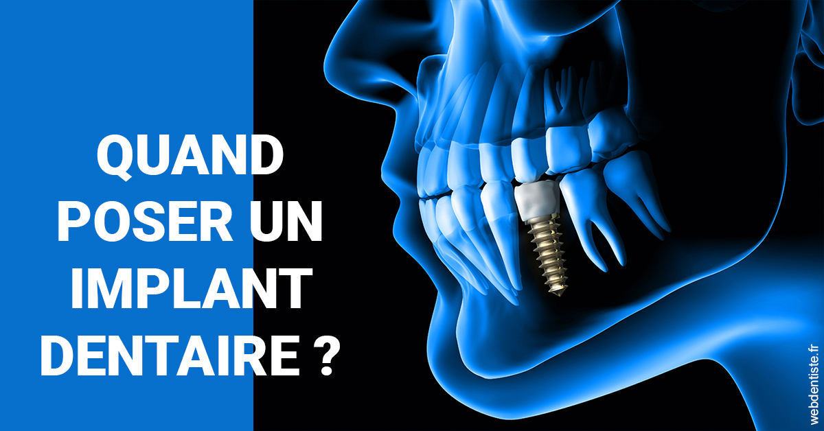 https://dr-bauer-patrick.chirurgiens-dentistes.fr/Les implants 1