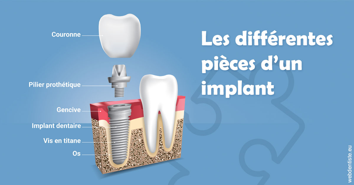 https://dr-bauer-patrick.chirurgiens-dentistes.fr/Les différentes pièces d’un implant 1